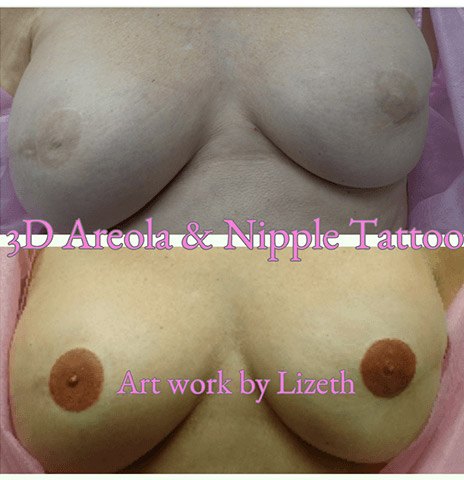 Patient before and after nipple tatooing