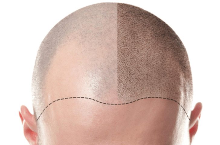 Scalp half before and half after micropigmentation