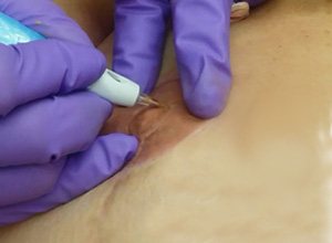 Patient receiving nipple tattooing
