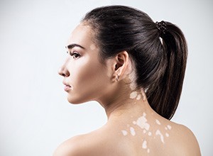 Woman with vitiligo