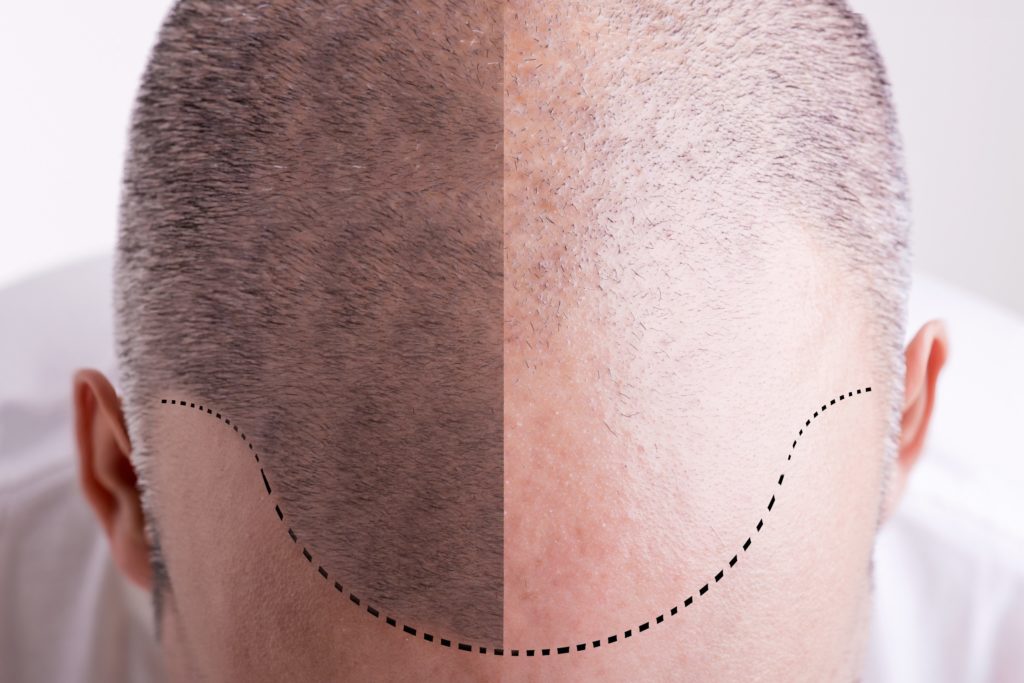 What is Scalp Micropigmentation in Fairfax and How It Helps?