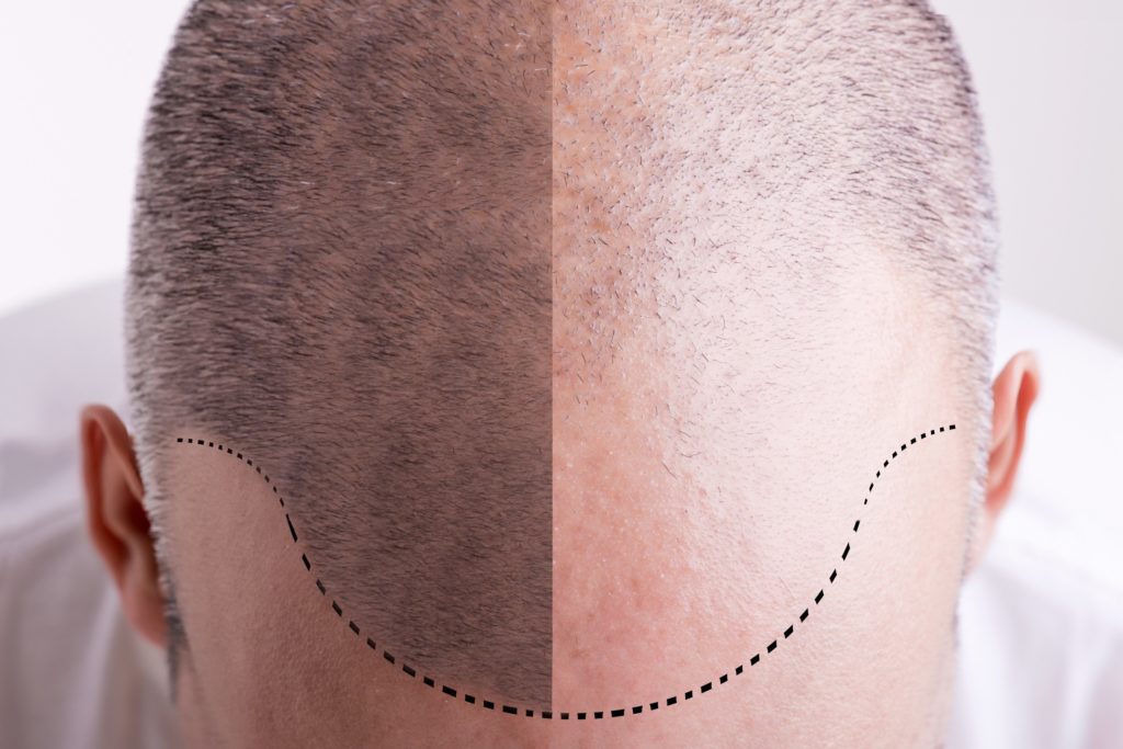 What is Scalp Micropigmentation in Fairfax and How It Helps? What is Scalp Micropigmentation in Fairfax and How It Helps?