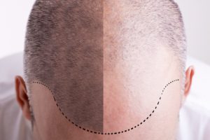 Male Pattern Baldness Solution